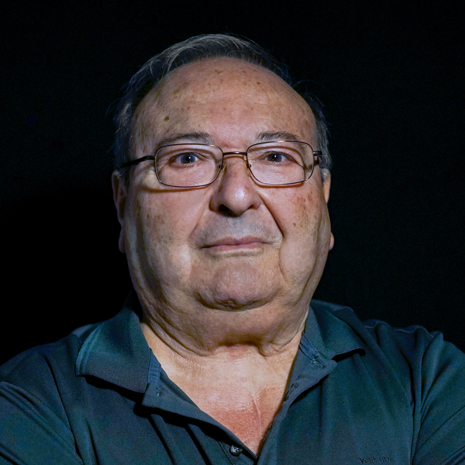 FERNANDO, 79 años. Estenosis aórtica severa con aorta en porcelana. Implante TAVI (2016).