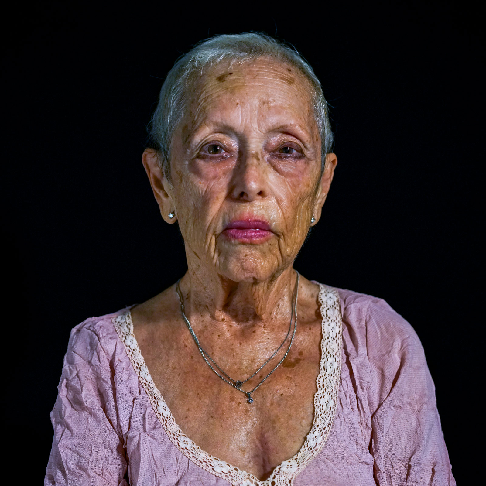 MARÍA CARMEN, 80 años. Insuficiencia mitral severa. Implante MitraClip (2024).
