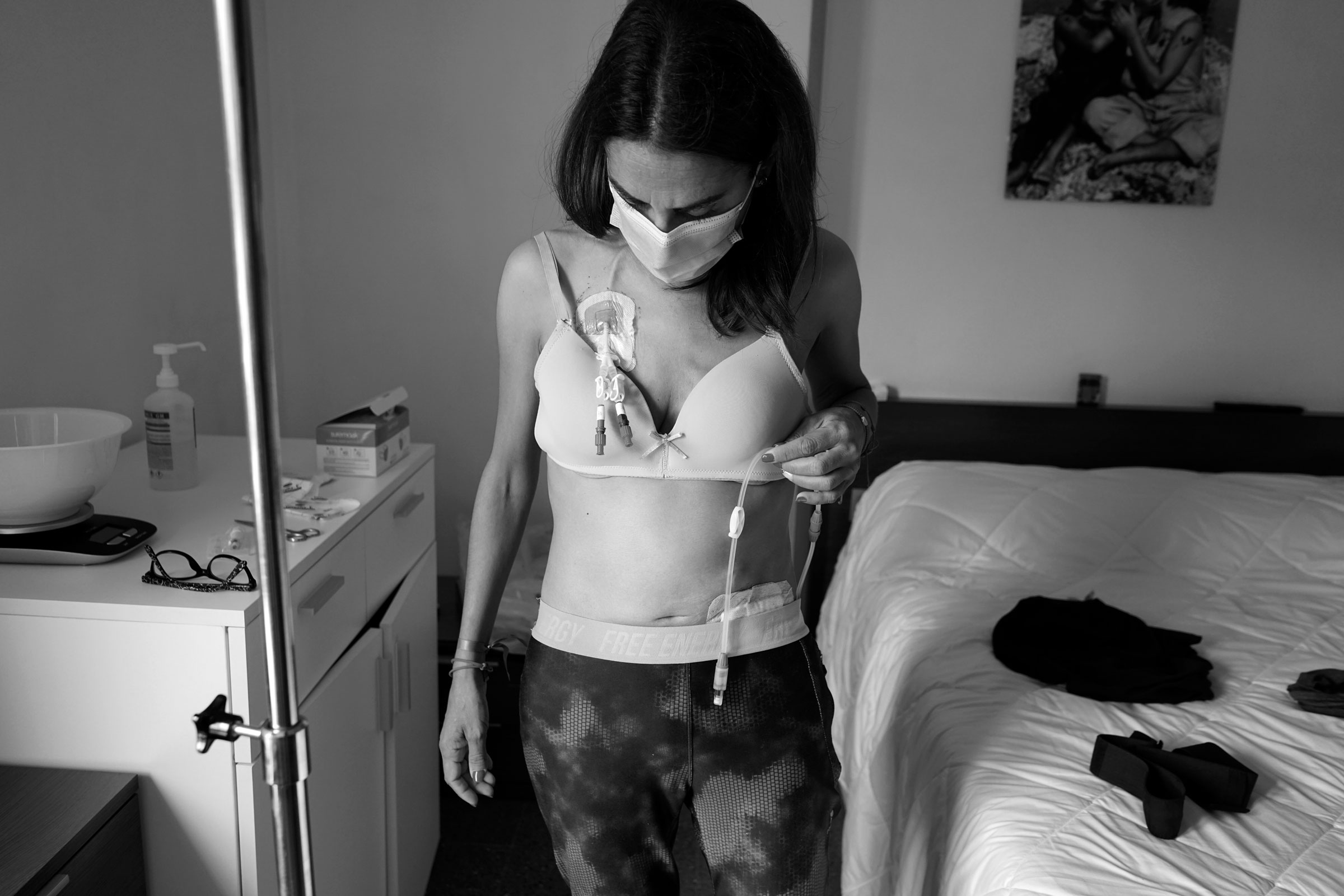 Valencia, España. Paciente se viste luego de tomar una ducha, y se acomoda uno de los dos catéteres en su cuerpo. En este caso en particular, la paciente necesitó diálisis urgente por presentar un edema agudo de pulmón por haberse acumulado mucho líquido en su cuerpo y en los pulmones, realizándole hemodiálisis a través de un catéter en el cuello. Posteriormente al no tolerar bien las sesiones de hemodiálisis tuvo que ser cambiada a la modalidad de diálisis peritoneal.