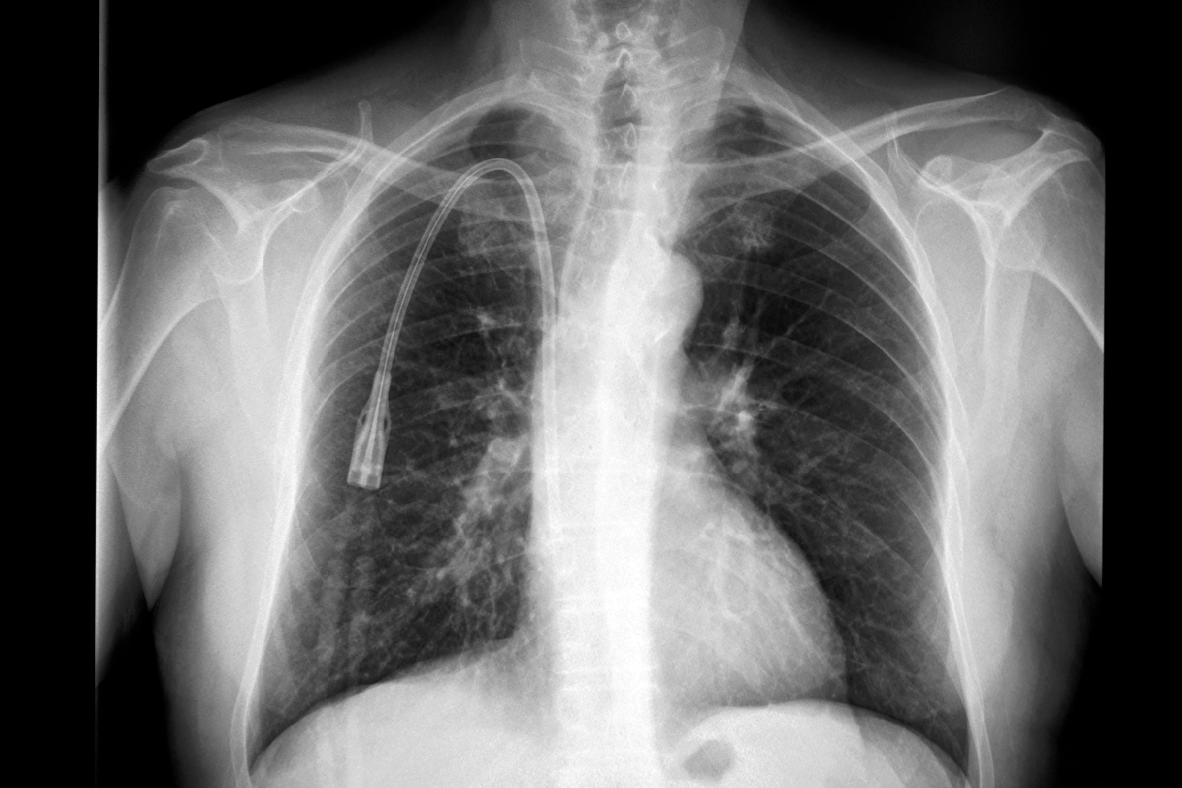 Una radiografía torácica muestra un catéter venoso central para hemodiálisis visible en la radiografía torácica. La punta del mismo está localizada en la aurícula derecha del corazón, (cavidad superior derecha).